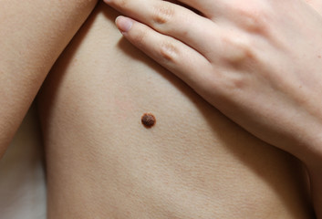Big birthmark on the girl's skin. Medical health photo.