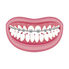 Dentist, orthodontist. Vector illustration. Braces on teeth. open mouth. White background. 