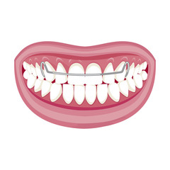 Dentist, orthodontist. Vector illustration. Braces on teeth. open mouth. White background. 