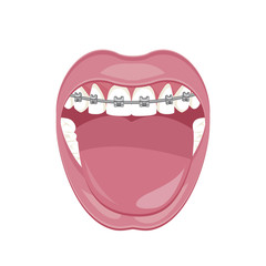 Dentist, orthodontist. Vector illustration. Braces on teeth. open mouth. White background. 