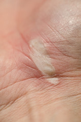 Burn, blister on wrist, hand skin, Second degree burn.