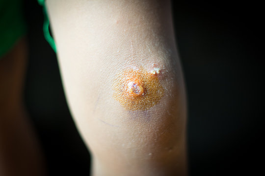 Purulent Pus On Child Knee Black Background