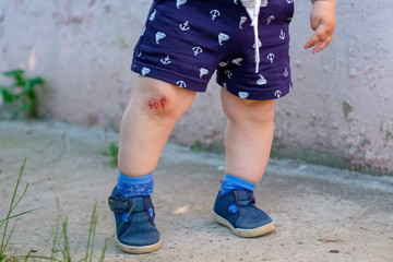 bloody abrasion on the child's knee
