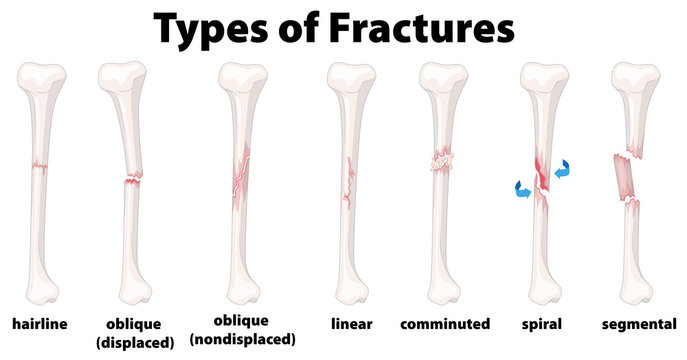 A Set of Bone Fractures