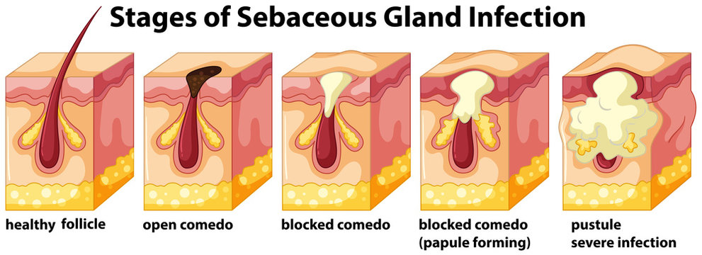 Stages of Sebaceous Gland Infection Stock Vector | Adobe Stock