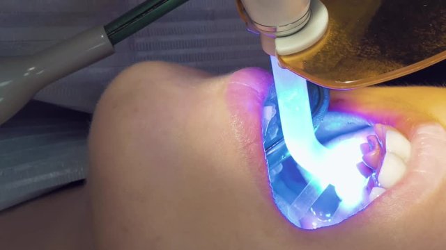 Woman at dentist clinic gets dental treatment to fill a cavity in a tooth. Dental restoration and material polymerization with UV light. Vertical format video.
