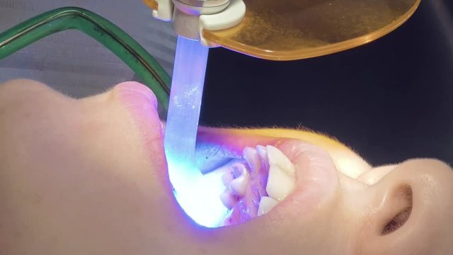 Woman at dentist clinic gets dental treatment to fill a cavity in a tooth. Dental restoration and material polymerization with UV light. Vertical format video.