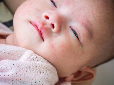 Newborn Baby With Allergy On Face