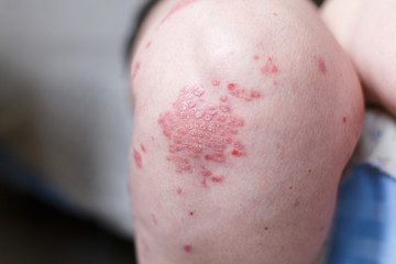 Fototapeta premium Allergic rash dermatitis eczema skin on leg of patient. Psoriasis and eczema skin with big red spots. Health concept