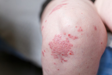 Fototapeta premium Allergic rash dermatitis eczema skin on leg of patient. Psoriasis and eczema skin with big red spots. Health concept