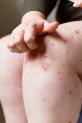 Naklejka premium Closeup women itching and scratching psoriasis spots by hand. Psoriasis or eczema on the skin. Atopic allergy skin with red spots