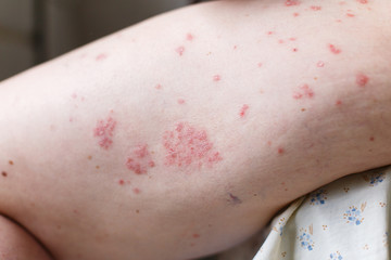 Fototapeta premium Allergic rash dermatitis eczema skin on leg of patient. Psoriasis and eczema skin with big red spots. Health concept