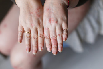 A picture of female hands one swollen because of a wasp sting. Red allergy spots on skin. Health...