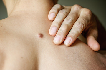 Fibroma on the male back, details, close-up - obrazy, fototapety, plakaty