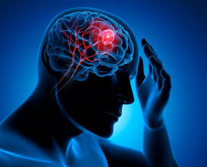 Kopfschmerz - Tumor im Hirn