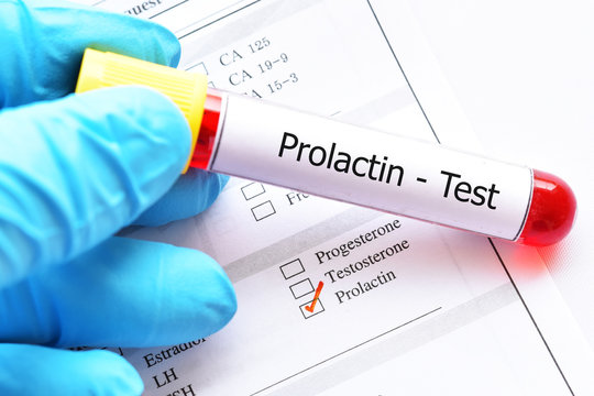 Blood sample tube with laboratory requisition form for prolactin hormone test