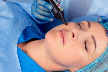 Woman having a non surgical procedure to remove nasolabial wrinkles