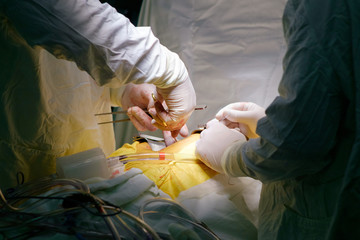 surgeons operating during cardiac operation of CABG