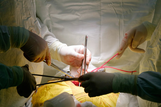 surgeons operating during cardiac operation of CABG