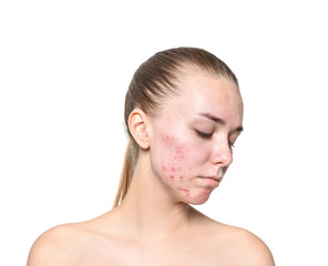 Young woman with acne problem on white background