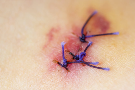 Scar from operation suture with a blue fiber. Scar after surgical removal of a birthmark. Closeup, selective focus