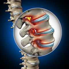 Spinal Stenosis Medical Concept - obrazy, fototapety, plakaty