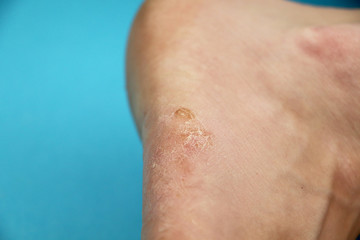 Fungus of foot close-up, isolated on blue background. The concept dermatology, treatment fungal and...