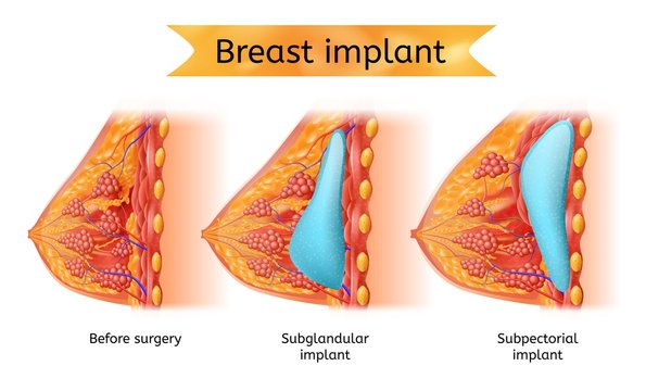 Brest Implant Procedure Vector Anatomical Cart