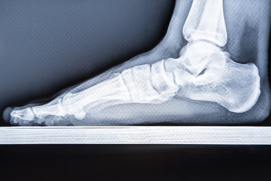 X-ray human foot with flatfoot