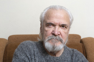 Eye disease in an old man