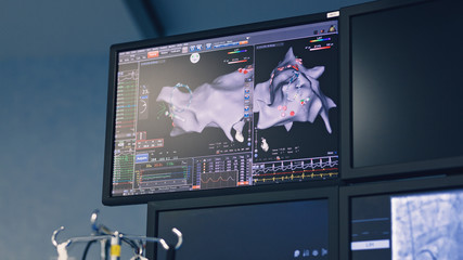 Electrophysiology study looks at the conduction or electrical system of your heart by recording electrical activity from within the heart chambers, to study heart rhythm disturbances, arrhythmias