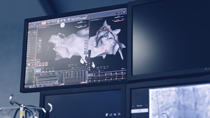 Heart electroanatomic map using new technologies focusing on new mapping tools especially in...