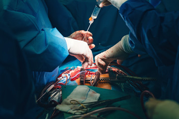 cardiovascular surgery team surgeons in surgery center for interventions with instruments in...