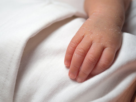 Closeup hand of a newborn with a skin peeling on white cloth. Skin allergies in newborn called Vernix. the concept of health care and medical.