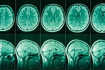 MRI of the head and brain of a person.