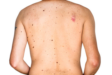 Detail of the bare skin on man in the back with scattered moles and freckles , Disorders of body ,...