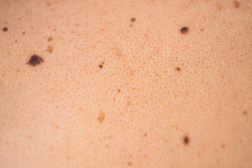 Fototapeta premium Detail of the bare skin on man in the back, Disorders of body with moles on skin growths include warts lot of wart, mole, birthmark, wart, gnarl, wart, Skin problems, Sun effect on skin.