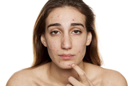 young woman with problematic skin and without makeup poses on a white background