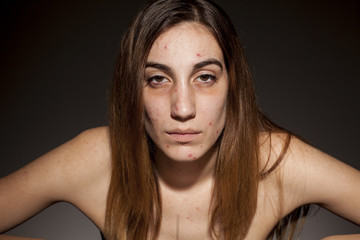 A girl with tired looks, problematic skin and dark circles around her eyes. Drugs addiction concept