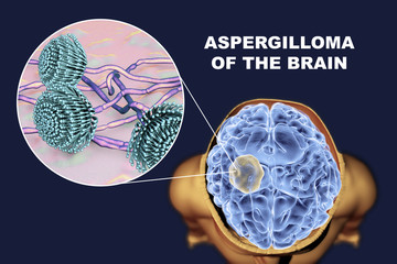 Aspergilloma of the brain and close-up view of fungi Aspergillus, 3D illustration. An intracranial lesion produced by fungi Aspergillus in immunocompromised patients