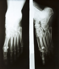 .Retgen photo of the female foot