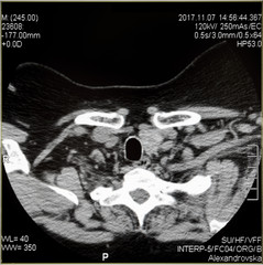 CT scans of human spine