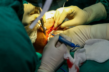 Patient during surgery to jaw bone treatment in operating room at hospital.