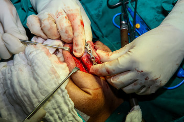 Patient during surgery to jaw bone treatment in operating room at hospital.
