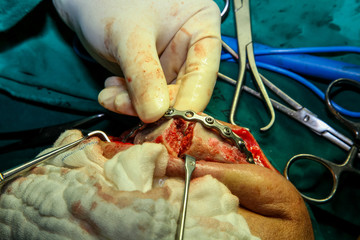 Patient during surgery to jaw bone treatment in operating room at hospital.