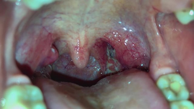 Angina, purulent tonsillitis, throat with pus on tonsils. The throat of a young girl, which is covered with white and black pus. 4k video.