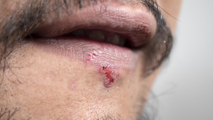 Herpes on the lips of the man