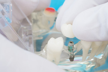 implant and orthodontic model for student to learning teaching model showing teeth.