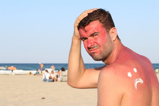 Sunburned man with lots of pain