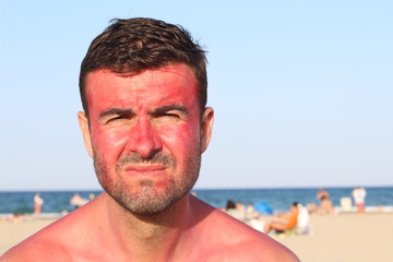 Man with lost of redness after suntanning